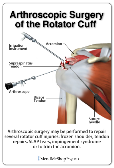 8 Tips to Speed Recovery After Rotator Cuff Surgery: Orthocenter