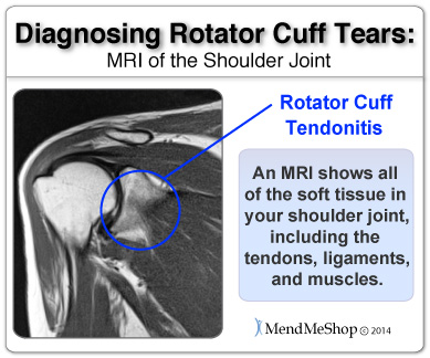 shoulder meniscus mri