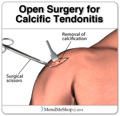Open surgery to remove calcium deposits causing calcific tendonitis pain.