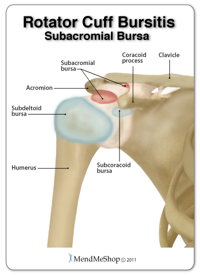 what causes septic bursitis