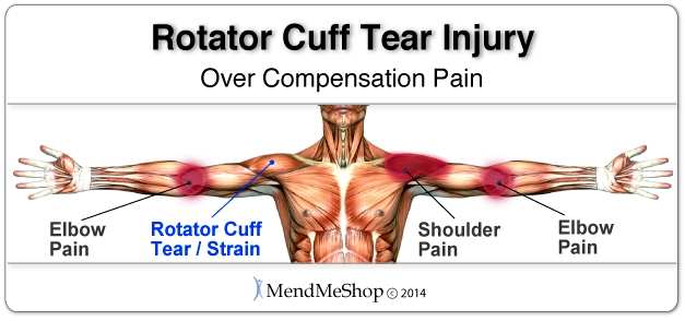Over compensation pain can result in a severe setback when recovering from a rotator cuff tear.