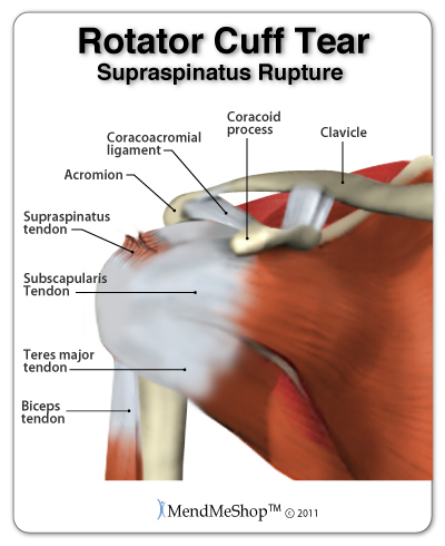 What You Should Do If You Think You May Have Torn Your Rotator