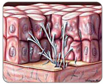 Scar tissue develops as damaged labrum tissue heals