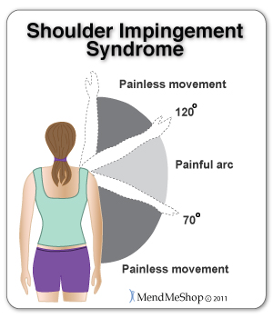 Shoulder Impingement Syndrome causes painful arc between 70°  and 120°. Treating early reduce risk of bursitis, tendinitis, bone spurs, and calcification of the tendon.