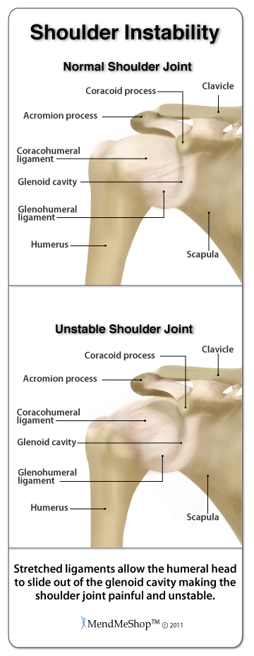 Shoulder instability often results from an injury to the glenohumeral joint.