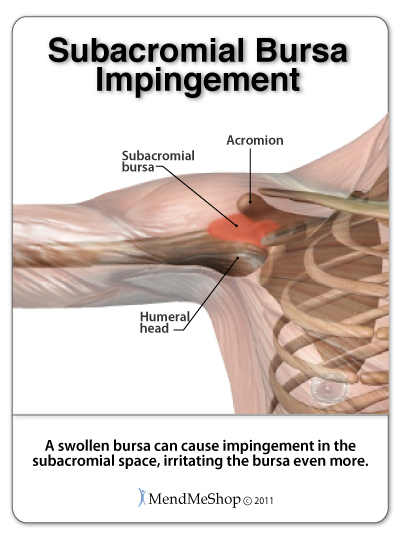 Shoulder Impingement Syndrome pinches the subacromial bursa and supraspinatus tendon within the subacromial space.