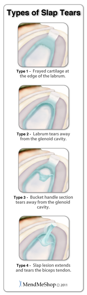 SLAP tears are graded based on severity. The types range from some fraying around the labrum to a complete bucket tear of the labrum and biceps tendon.