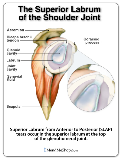 The superior labrum may tear (superior labrum from anterior to posterior tears) at the top of the shoulder (glenohumeral) joint.